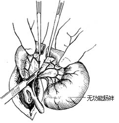 先天性肠闭锁和肠狭窄一期切除吻合术图片