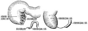 先天性肠闭锁和肠狭窄一期切除吻合术图片