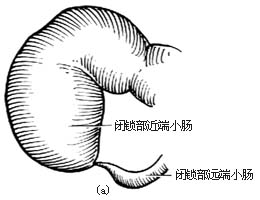 先天性肠闭锁和肠狭窄一期切除吻合术图片