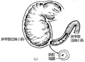 先天性肠闭锁和肠狭窄一期切除吻合术图片