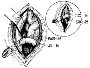 先天性肠闭锁和肠狭窄一期切除吻合术图片