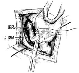 阑尾切除术图片