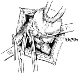 阑尾切除术图片