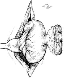 侧壁肠瘘闭合术图片