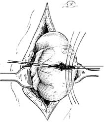 侧壁肠瘘闭合术图片
