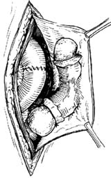 双口式肠瘘闭合术图片