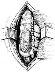 右半结肠切除术图片