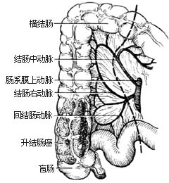 右半结肠切除术图片