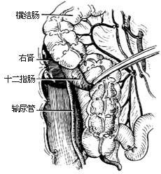 右半结肠切除术图片