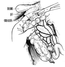 右半结肠切除术图片