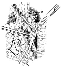 左半结肠切除术图片
