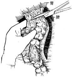 左半结肠切除术图片