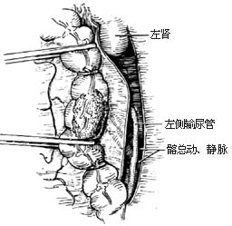 左半结肠切除术图片