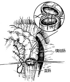 左半结肠切除术图片