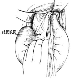 结肠直肠切除肛门外吻合术图片