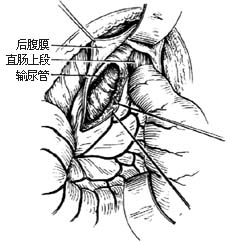 结肠直肠切除肛门外吻合术图片