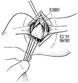 先天性直肠肛门畸形的手术图片