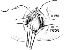 先天性直肠肛门畸形的手术图片