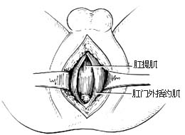 先天性直肠肛门畸形的手术图片