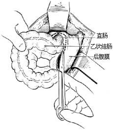 先天性直肠肛门畸形的手术图片