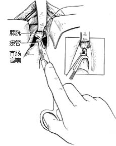 先天性直肠肛门畸形的手术图片