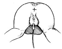 先天性直肠肛门畸形的手术图片