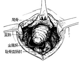 先天性直肠肛门畸形的手术图片