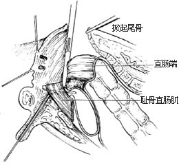 先天性直肠肛门畸形的手术图片