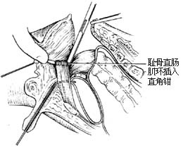 先天性直肠肛门畸形的手术图片