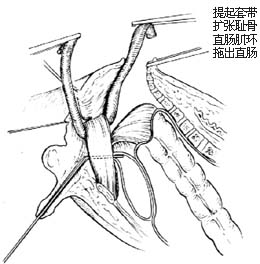 先天性直肠肛门畸形的手术图片