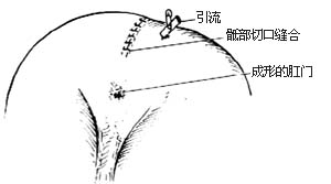 先天性直肠肛门畸形的手术图片