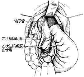 结肠直肠切除肛门外吻合术图片