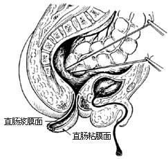结肠直肠切除肛门外吻合术图片