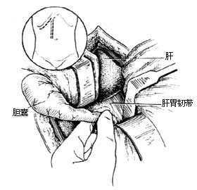 胆囊造瘘术图片