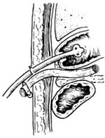 胆囊造瘘术图片