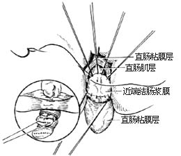 结肠直肠切除肛门外吻合术图片