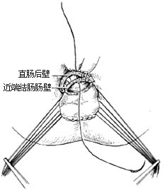 结肠直肠切除肛门外吻合术图片