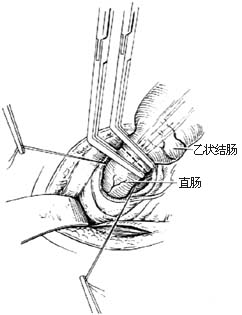 结肠直肠切除直肠后吻合术图片