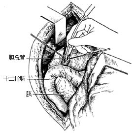 十二指肠乳头括约肌成形术（经十二指肠）图片