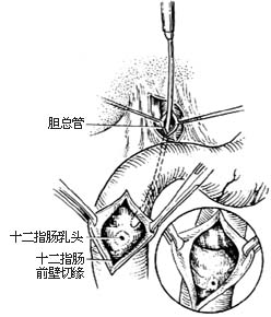 十二指肠乳头括约肌成形术（经十二指肠）图片