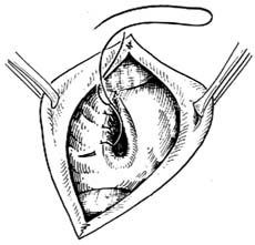 十二指肠乳头括约肌成形术（经十二指肠）图片