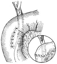 十二指肠乳头括约肌成形术（经十二指肠）图片