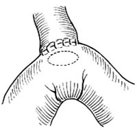 胆总管十二指肠侧侧吻合术图片