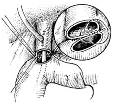 胆总管十二指肠端侧吻合术图片