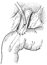 胆总管十二指肠端侧吻合术图片