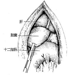 胆囊十二指肠吻合术图片