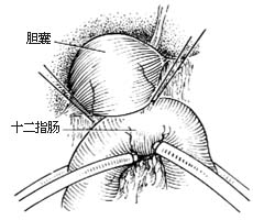 胆囊十二指肠吻合术图片