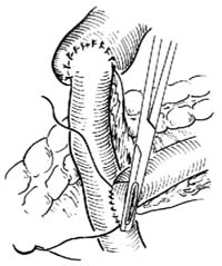 胆囊空肠Y形吻合术图片