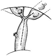 胆管空肠Roux-Y式吻合术图片