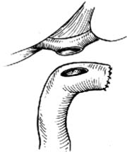 胆管空肠Roux-Y式吻合术图片